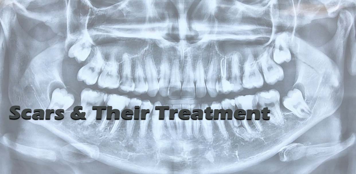 Scars & Their Treatment